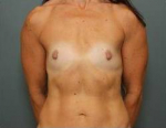 BREAST AUGMENTATION: Case 27 Before